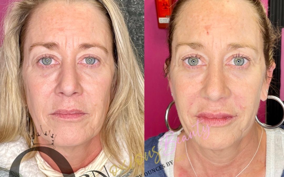 Reveal Brighter, Smoother Skin Naturally PRP Microneedling Is Here!