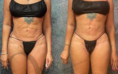 Refine Your Contours: Post-Lipo Fibrosis Treatment with Vela V9 in Buckhead