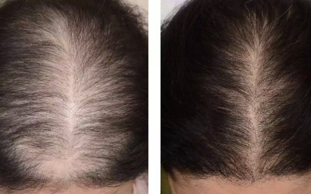 All I Want For Christmas Is More Hair: Well Here Comes Exosomes!