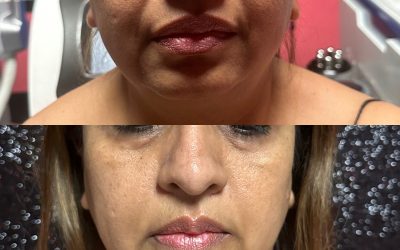 Smoother Smile Lines, Brighter Under-Eyes, The Power of Ultherapy & Vela V9 in Atlanta